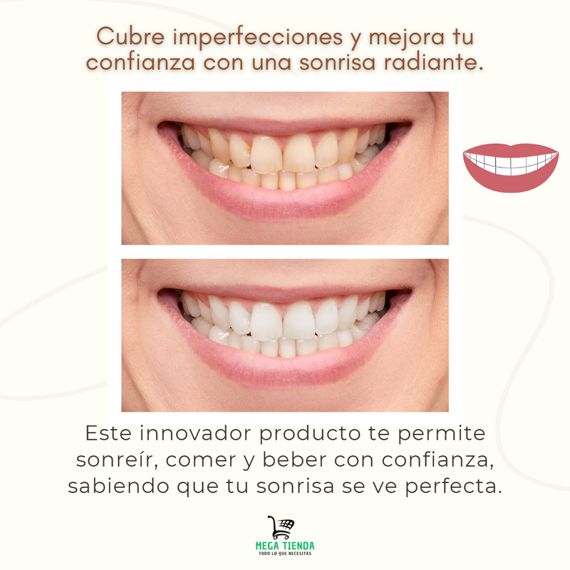 Facetas Dentales™  Sonrisa Perfecta