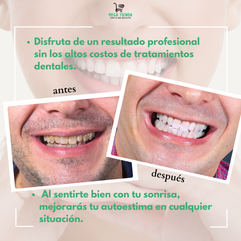 Facetas Dentales™  Sonrisa Perfecta